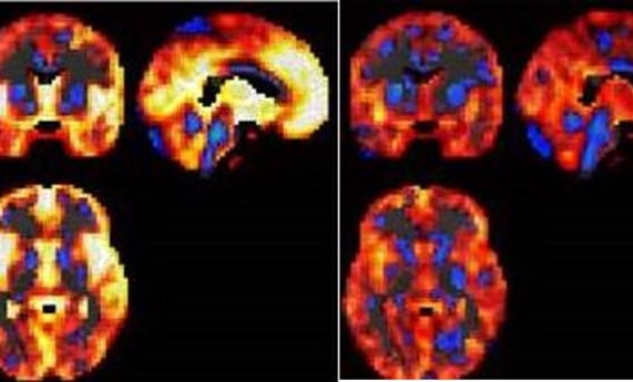 La combinación de neuroimagen y aprendizaje automático, nuevas vías para el diagnóstico del  trastorno bipolar