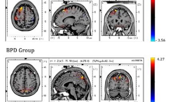 Las personas con trastorno límite de la personalidad activan regiones cerebrales distintas para controlar sus impulsos