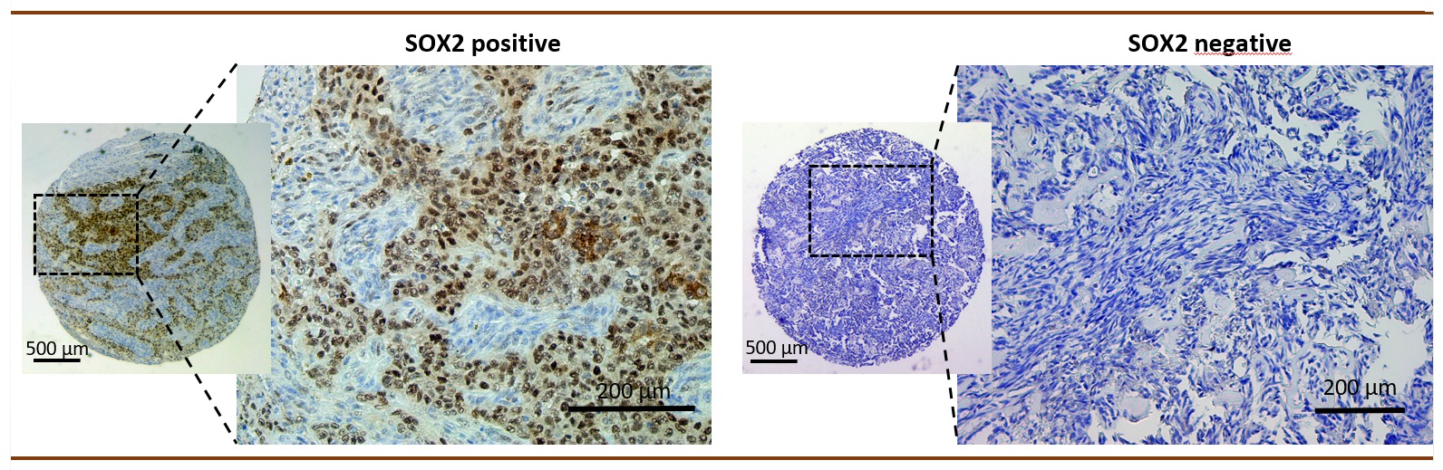 La proteína SOX2, posible biomarcador para conocer la evolución tumoral y la eficacia de fármacos en un tipo de sarcoma