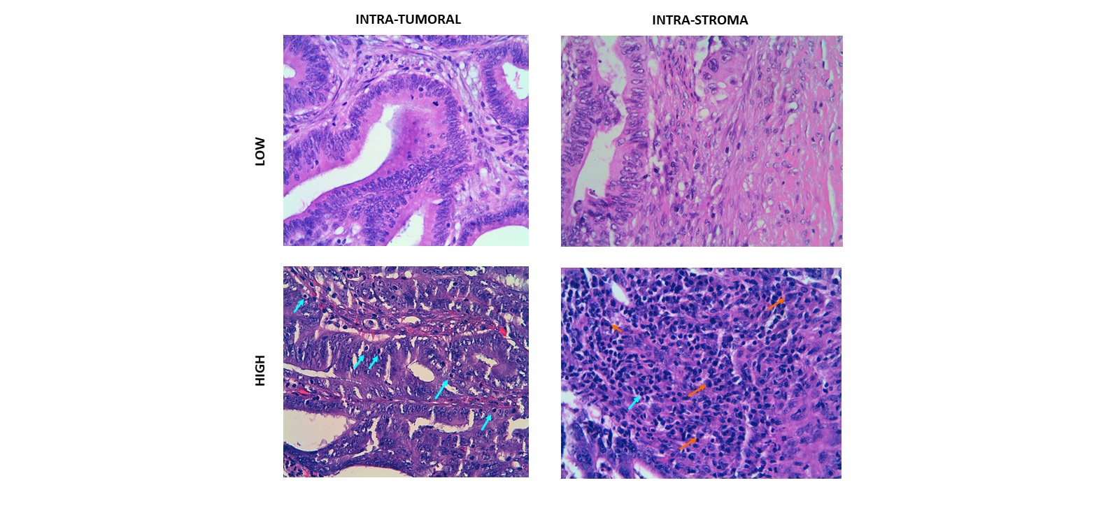 Un estudio de biomarcadores en secuenciación del ADN demuestra que la cantidad y clonalidad de TCRs asocia claramente al pronóstico del cáncer colorrectal