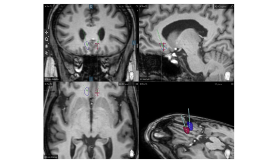 Realizan el primer estudio en el que se aplica la estimulación cerebral profunda (DBS) en pacientes con esquizofrenia resistente al tratamiento