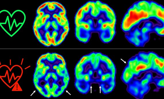 Cuanto antes empecemos a controlar los factores de riesgo cardiovascular, mejor para nuestro cerebro Cuanto antes empecemos a controlar los factores de riesgo cardiovascular, mejor para nuestro cerebro