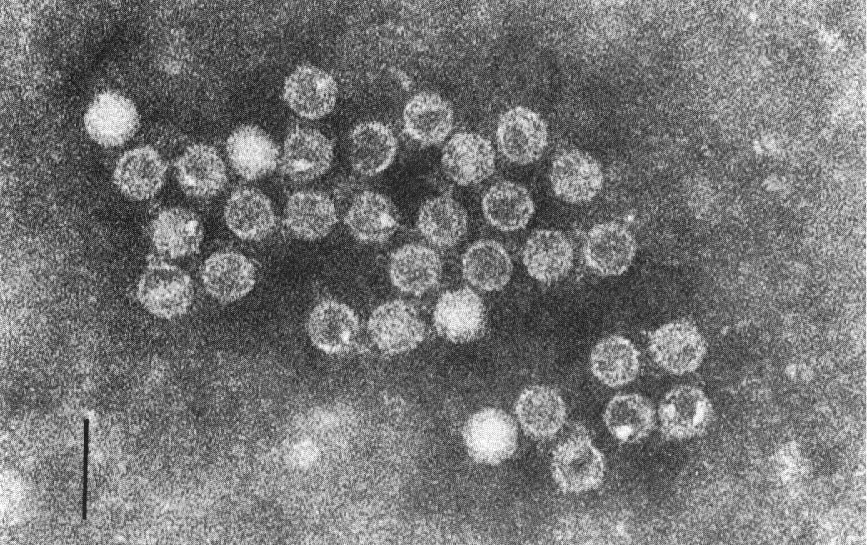 Primeras detecciones en España de un tipo de enterovirus poco conocido ligado a enfermedad respiratoria y neurológica