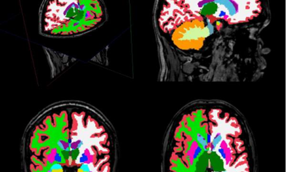 Describen alteraciones en estructuras cerebrales en pacientes con esquizofrenia descubiertas mediante un innovador análisis de imagen cerebral