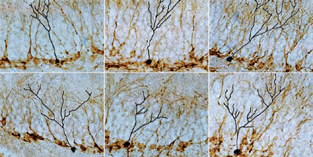 Describen una estrategia terapéutica para la depresión basada en técnicas moleculares que silencian el transportador de serotonina