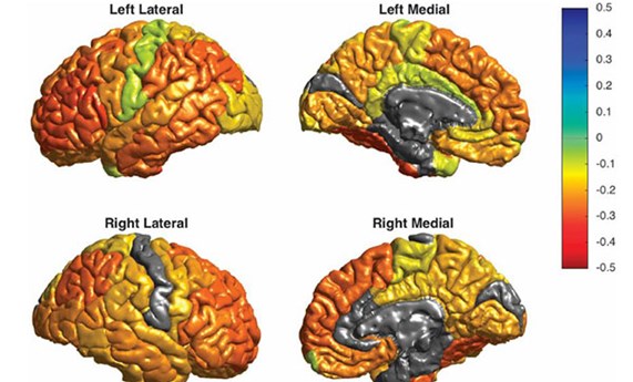 Elaborado el primer mapa global de las alteraciones cerebrales en pacientes con trastorno bipolar