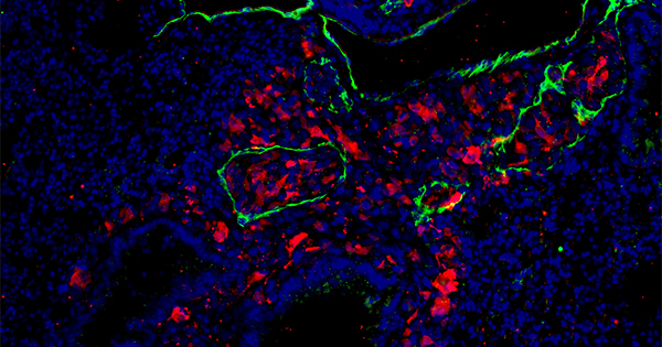 Visualizan las metástasis del melanoma antes de que ocurran e identifican nuevas dianas para su tratamiento